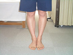 O脚矯正2